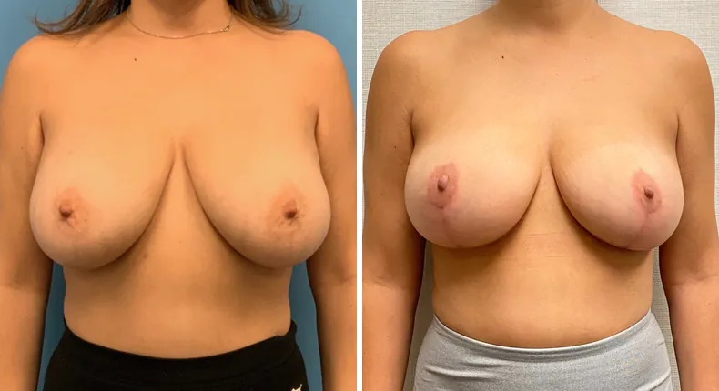 Before and after breast reduction: patient's breasts from the front