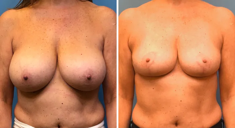 Before and after breast reduction: woman's breasts from the front