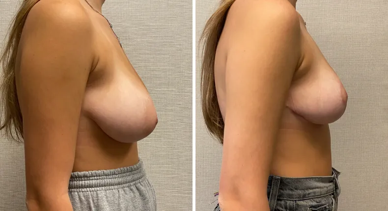 Before and after breast reduction: woman's breasts from the right side
