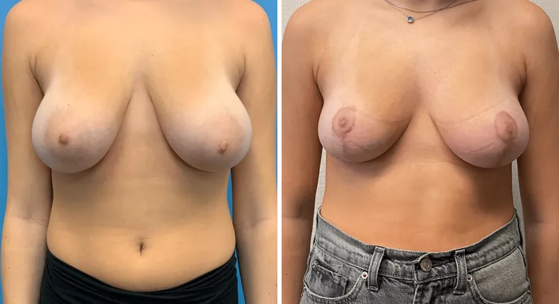 Before and after breast reduction: patient's breasts from the front