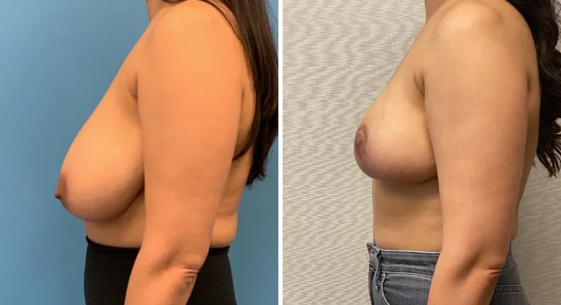 Before and after breast reduction: woman's breasts from the left side
