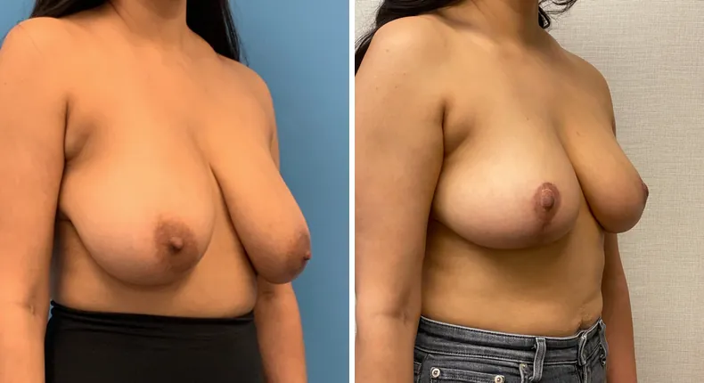 Before and after breast reduction: woman's breasts at a right angle