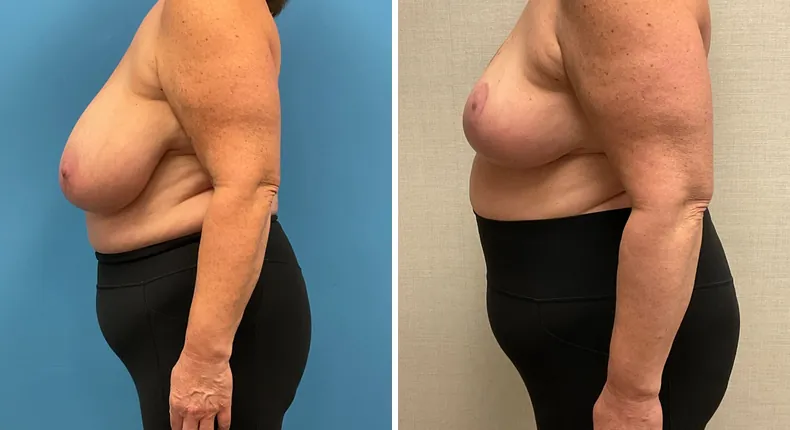 Before and after breast reduction: patient's breasts in left profile