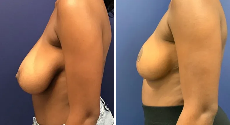 Before and after breast reduction: patient's breasts from the left side