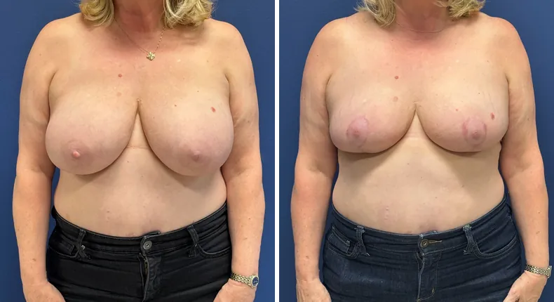 Before and after breast reduction: patient's breasts from the front