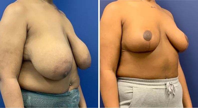 Before and after breast reduction: patient's breasts at a right angle
