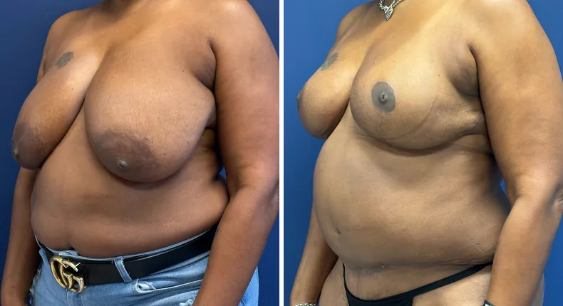 Before and after breast reduction: patient's breasts from the left side
