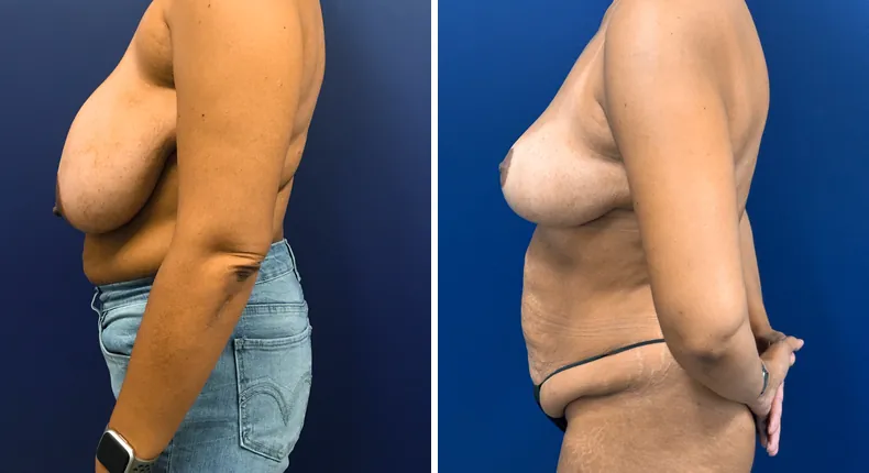 Before and after breast reduction: patient's breasts in left profile