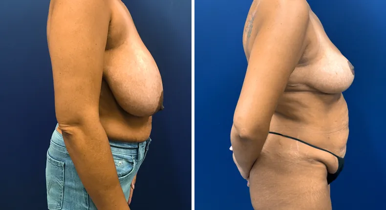 Before and after breast reduction: patient's breasts in right profile
