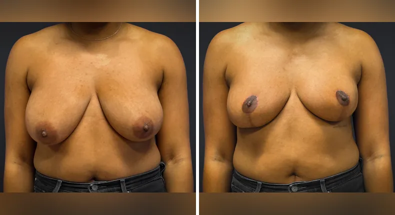 Before and after breast reduction: patient's breasts