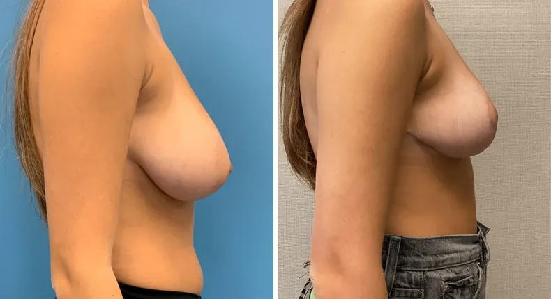 Before and after breast reduction: patient's breasts in right profile