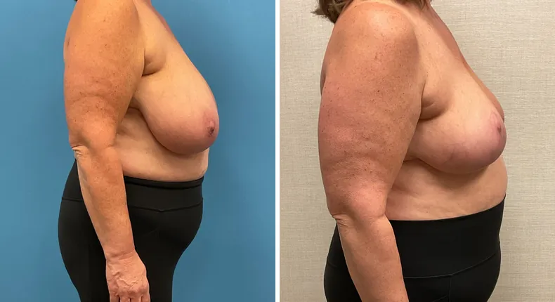 Before and after breast reduction: patient's breasts in right profile