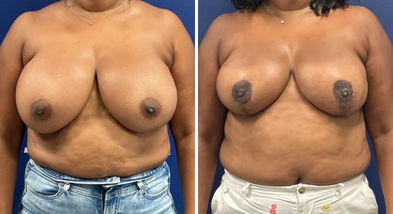Before and after breast reduction: patient's breasts from the front