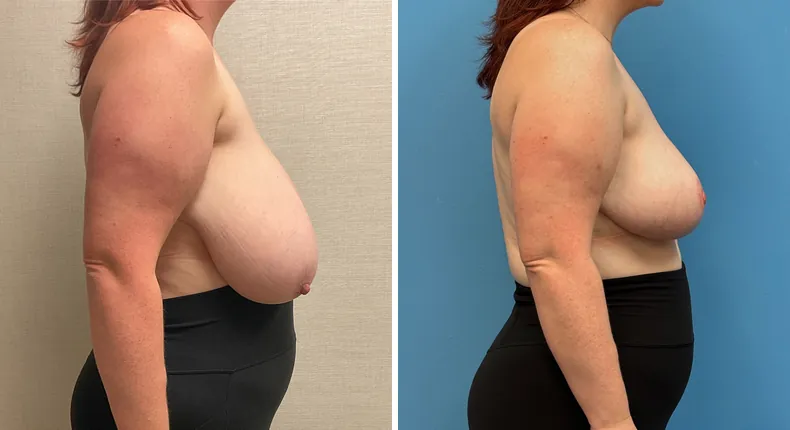 Before and after breast reduction: patient's breasts from the right side