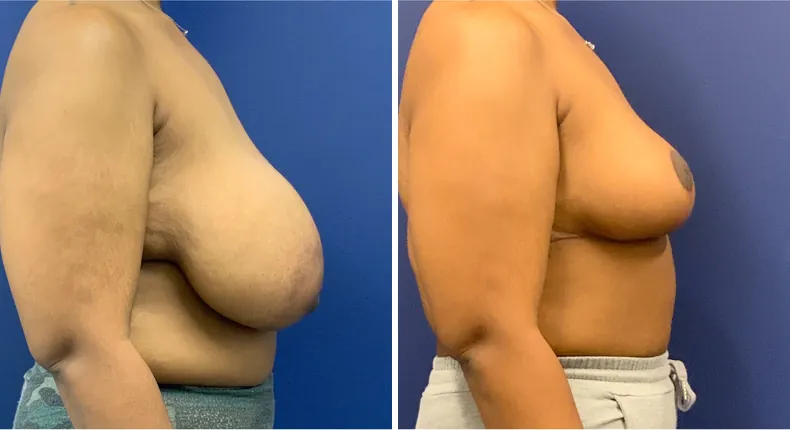 Before and after breast reduction: patient's breasts from the right side