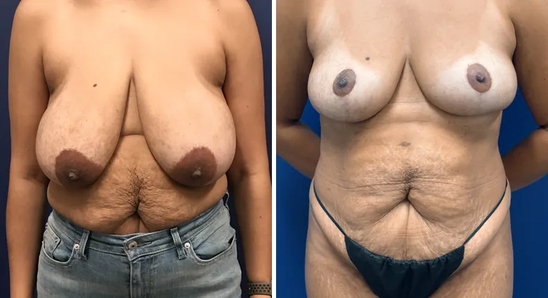 Before and after breast reduction: patient's breasts