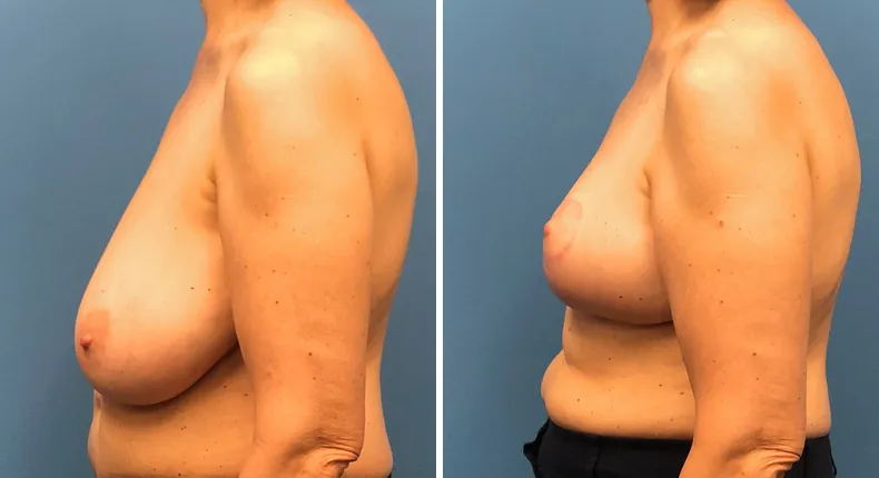 Before and after breast reduction: woman's breasts from the left side