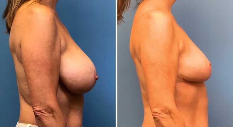 Before and after breast reduction: woman's breasts from the right side