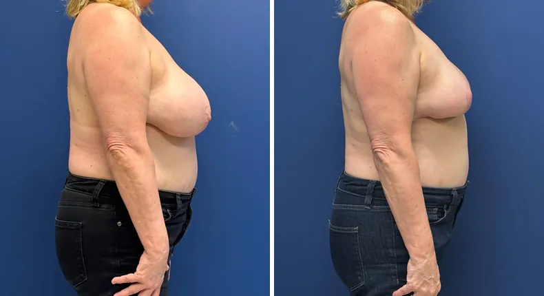 Before and after breast reduction: patient's breasts from the right side
