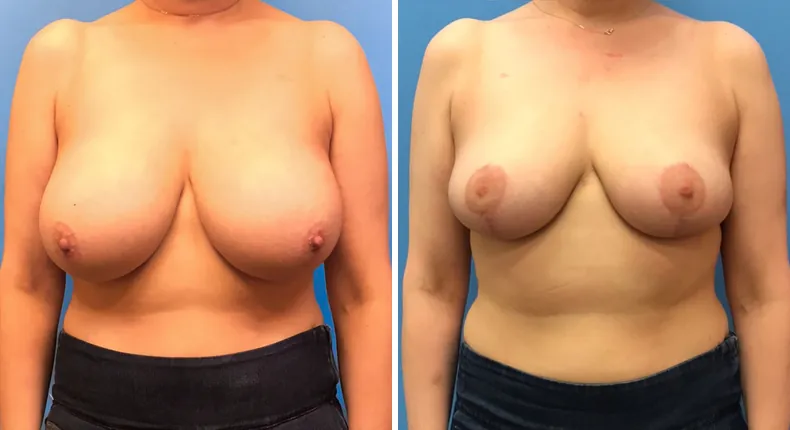 Before and after breast reduction: woman's breasts from the front
