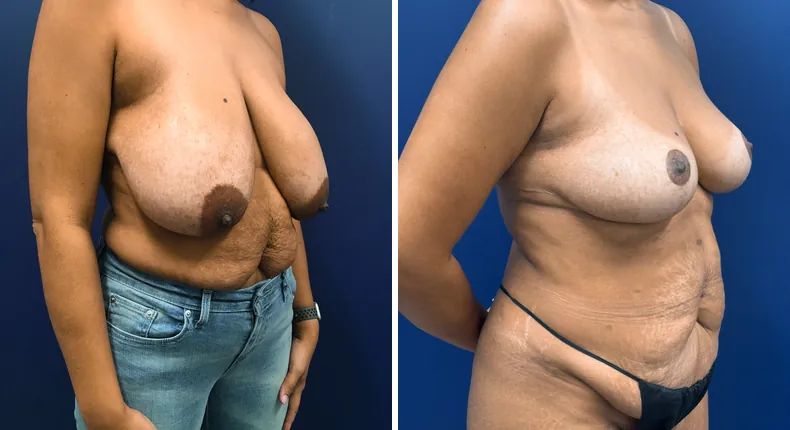 Before and after breast reduction: patient's breasts from the right side