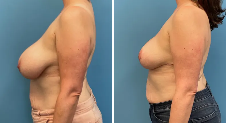 Before and after breast reduction: patient's breasts from the left side