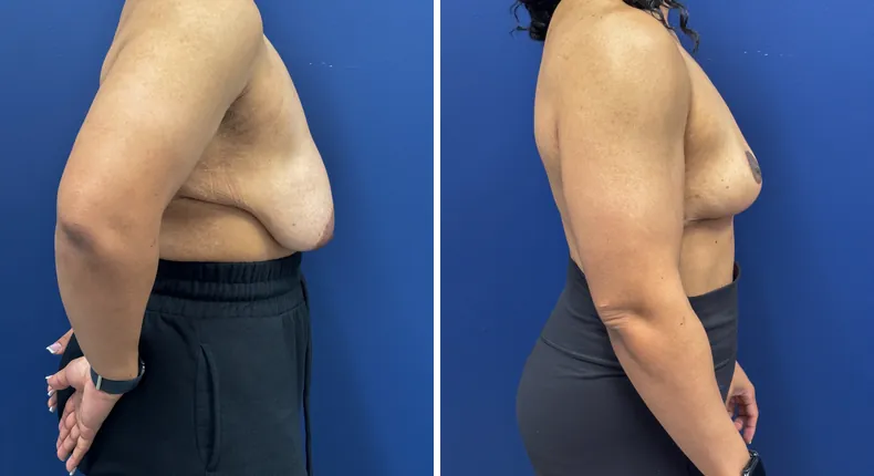 Before and after breast reduction: patient's breasts in right profile