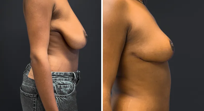 Before and after breast reduction: patient's breasts from the right side
