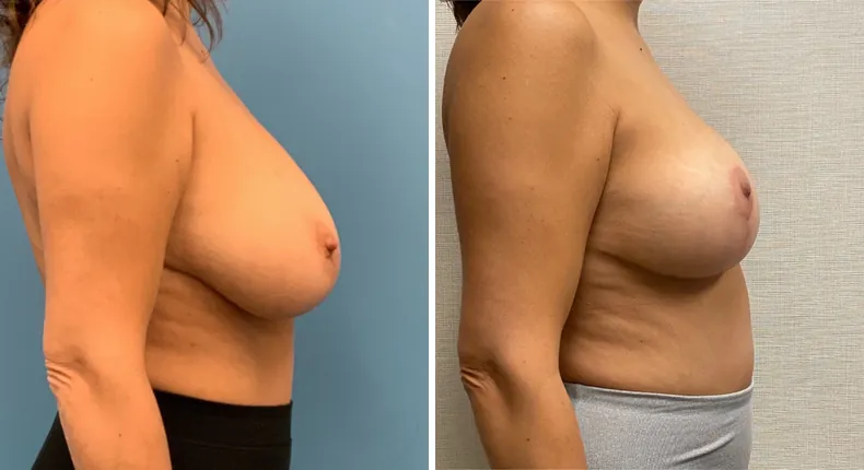 Before and after breast reduction: patient's breasts from the right side