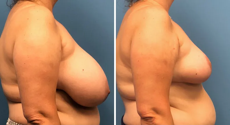 Before and after breast reduction: patient's breasts from the right side