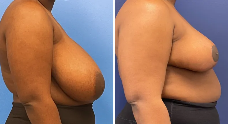 Before and after breast reduction: patient's breasts from the right side