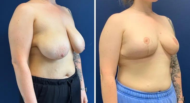 Before and after breast reduction: patient's breasts at a right angle