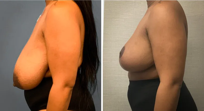 Before and after breast reduction: patient's breasts from the left side