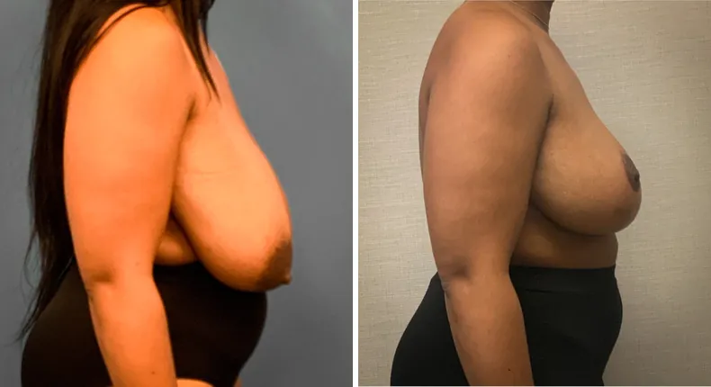 Before and after breast reduction: patient's breasts from the right side