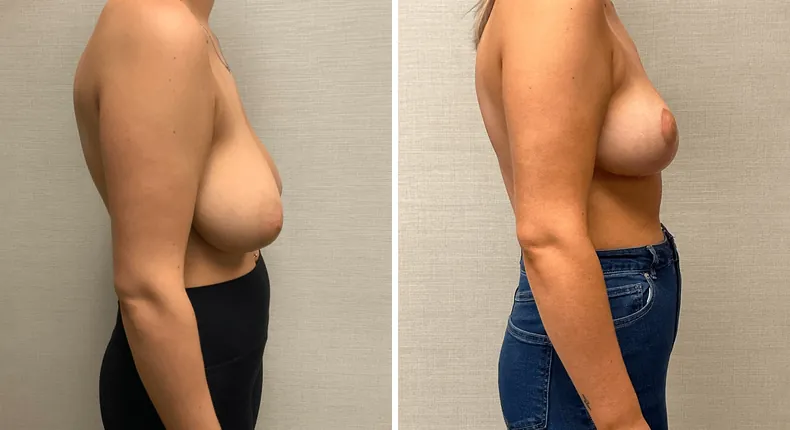 Before and after breast reduction: patient's breasts in right profile