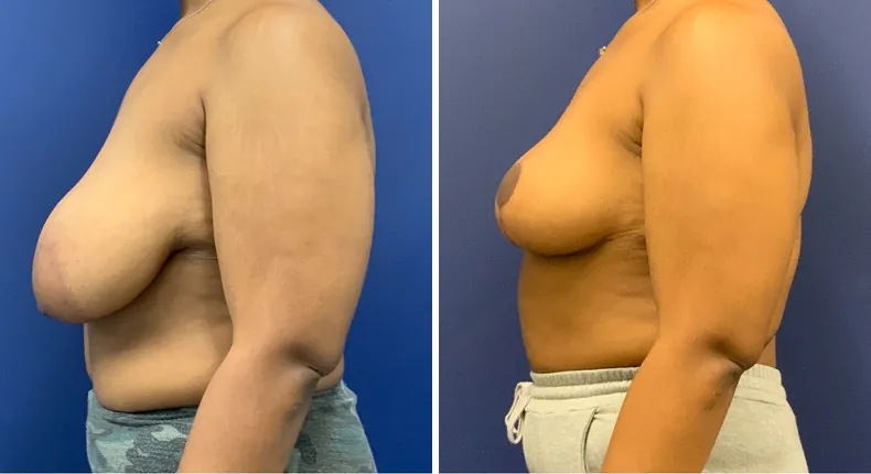Before and after breast reduction: patient's breasts from the left side