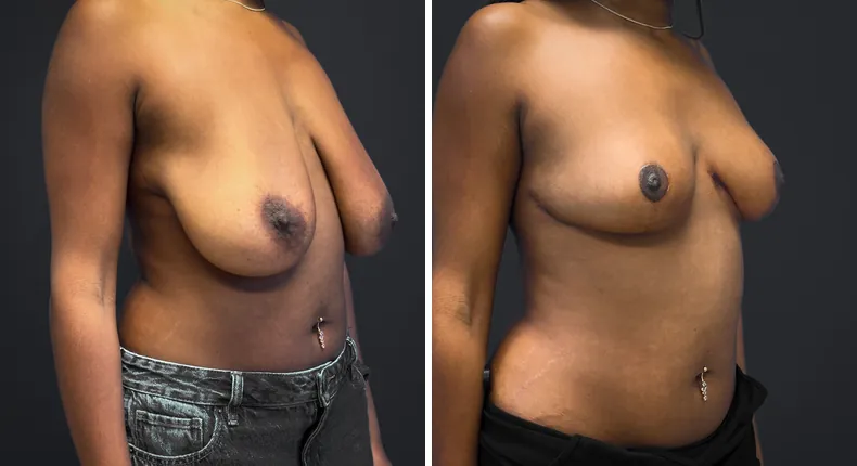 Before and after breast reduction: patient's breasts from the right side