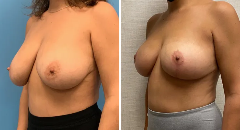Before and after breast reduction: patient's breasts at a left angle