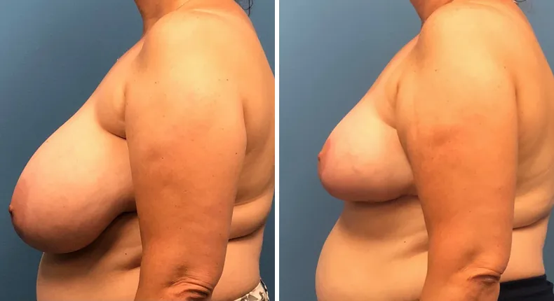 Before and after breast reduction: patient's breasts from the left side