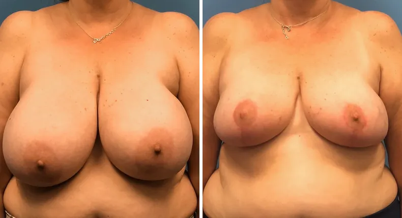 Before and after breast reduction: patient's breasts