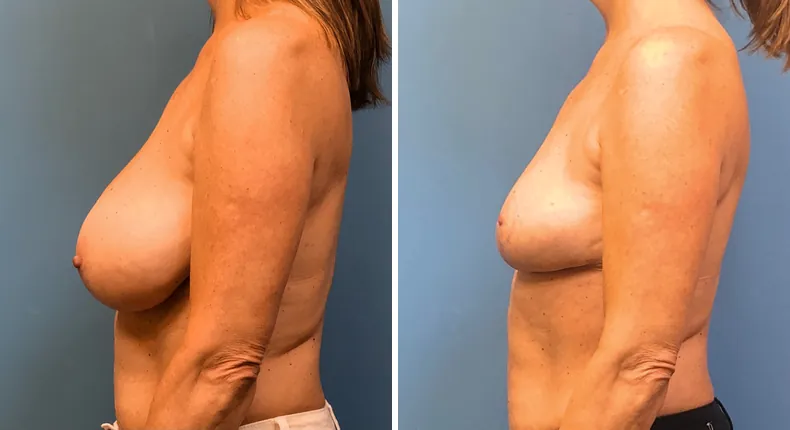 Before and after breast reduction: woman's breasts from the left side