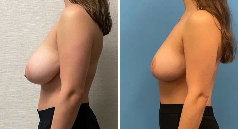 Before and after breast reduction: woman's breasts from the left side