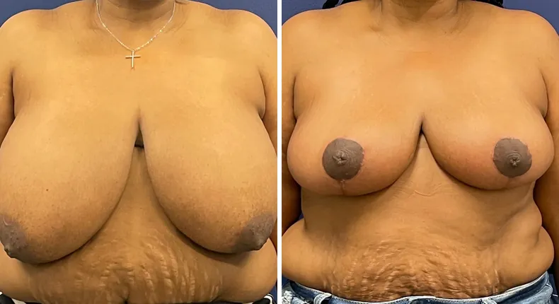 Before and after breast reduction: woman's breasts from the front