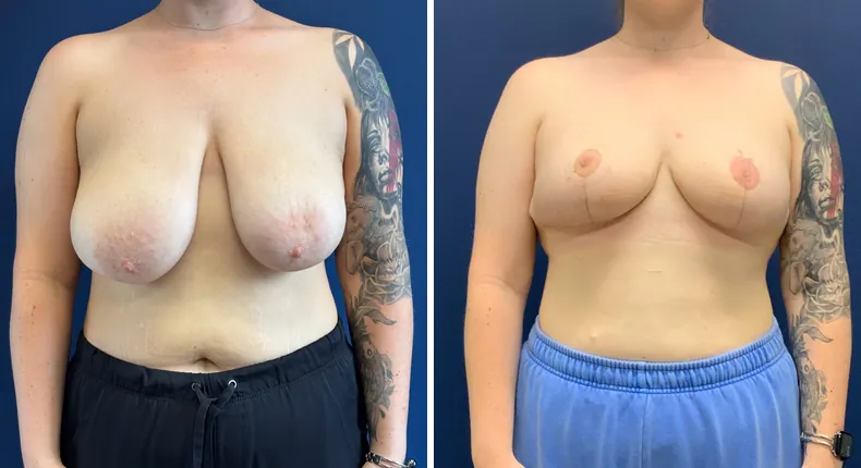 Before and after breast reduction: patient's breasts