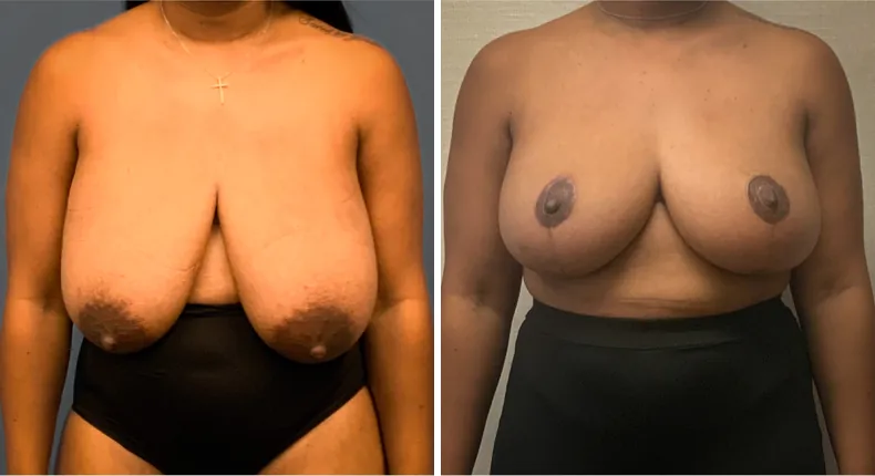 Before and after breast reduction: patient's breasts from the front
