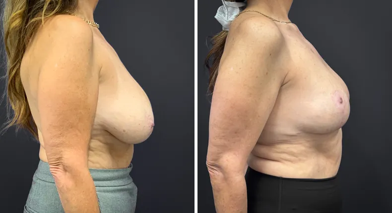 Before and after breast reduction: patient's breasts from the right side
