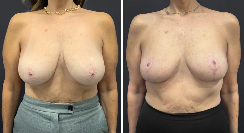 Before and after breast reduction: patient's breasts from the front