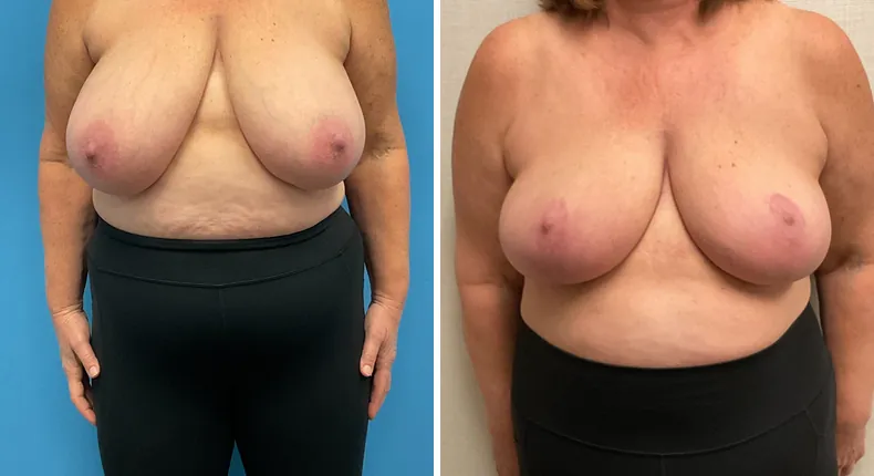 Before and after breast reduction: patient's breasts