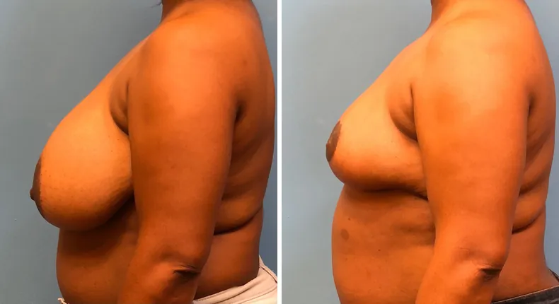 Before and after breast reduction: patient's breasts from the left side