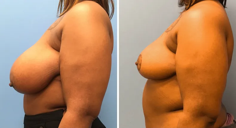 Before and after breast reduction: woman's breasts from the left side